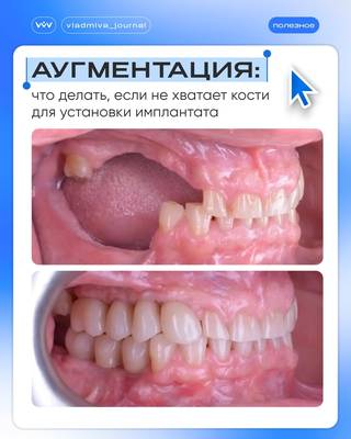 Дефицит кости — не приговор: остеопластика решает.